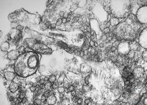 F, 47y. | phagocytosed collagen (unclassified dermal lesion) F, 47y. | phagocytosed collagen (unclassified dermal lesion)